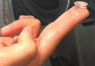 Inserting scleral contact lenses with 2 fingers